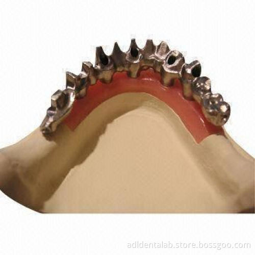 Implant Bridge